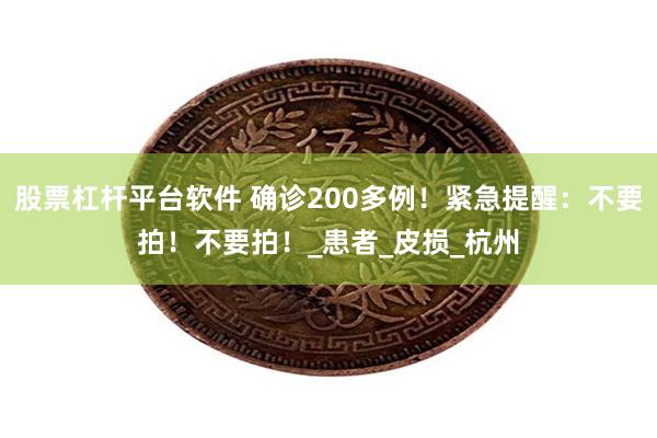股票杠杆平台软件 确诊200多例！紧急提醒：不要拍！不要拍！_患者_皮损_杭州